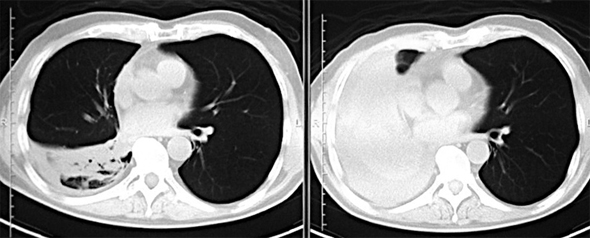 左：4月26日の右肺下部。右；5月10日の同部。